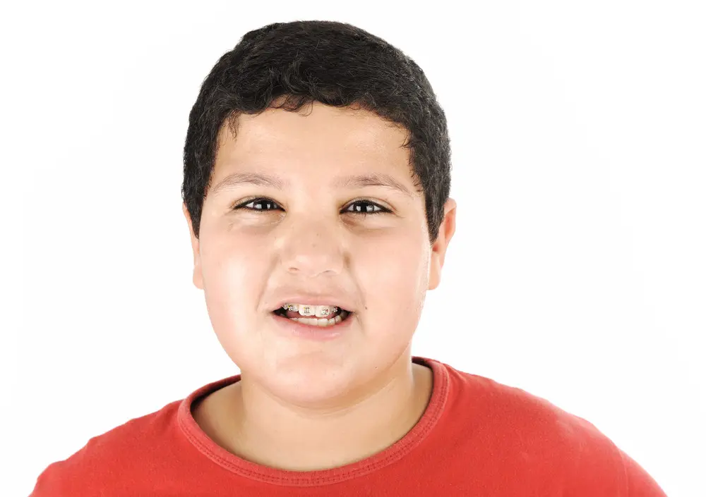 braces for straight teeth