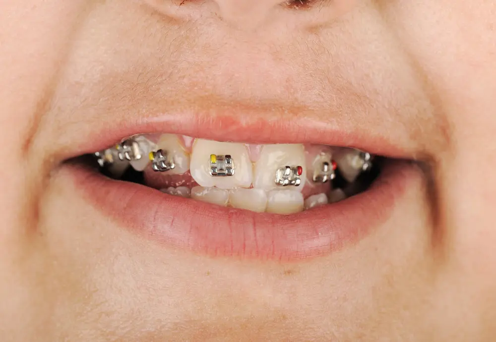 braces for adults