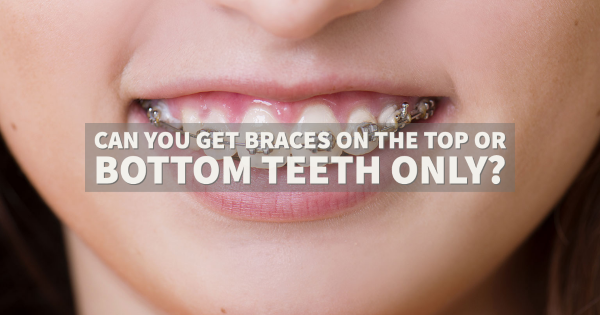 Can You Get Braces on the Top or Bottom Teeth Only?